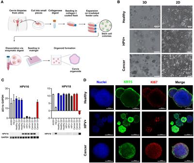 γδ T cell-mediated cytotoxicity against patient-derived healthy and cancer cervical organoids